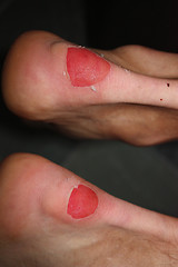 Image showing Blister