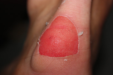 Image showing blister