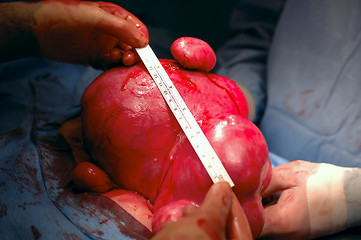 Image showing Extraordinary Diseased Uterus