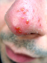 Image showing Nose Cold Sore