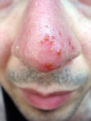 Image showing Nose Cold Sore