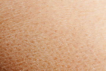 Image showing Dry Skin