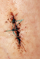 Image showing Stitches