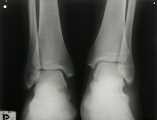 Image showing X-ray photo of person's ankles