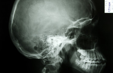 Image showing X-ray photo of a human skull