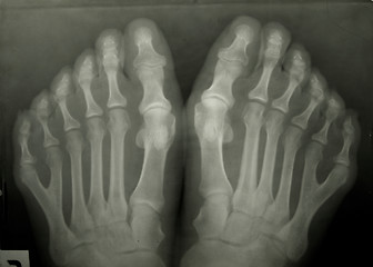 Image showing X-ray photo of person's toes. 6 toes!