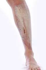 Image showing psoriasis