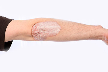 Image showing psoriasis