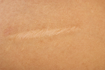 Image showing scar on skin