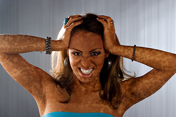 Image showing Vitiligo Skin Condition