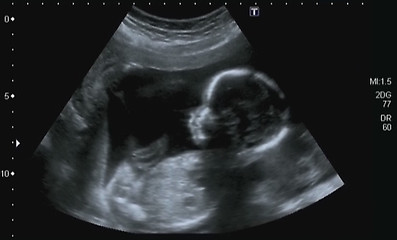 Image showing Obstetric Ultrasonography