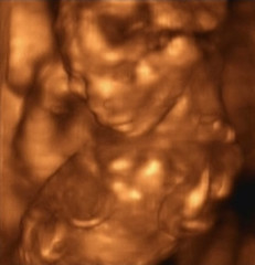 Image showing Three Dimensional Ultrasound