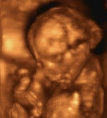 Image showing Three Dimensional Ultrasound