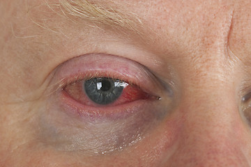 Image showing Bloodshot eye