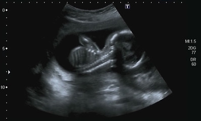 Image showing Obstetric Ultrasonography