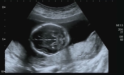 Image showing Obstetric Ultrasonography