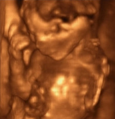 Image showing Three Dimensional Ultrasound