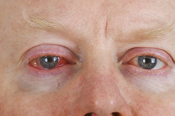 Image showing Bloodshot eye