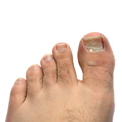 Image showing Cracked Fungus Toe Nail