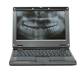 Image showing small laptop with dental picture of jaw