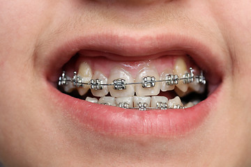 Image showing children teeth with braces