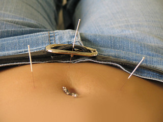 Image showing Acupuncture