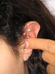 Image showing Acupuncture