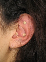 Image showing Acupuncture