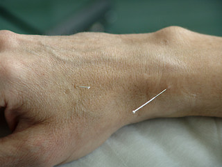 Image showing Acupuncture