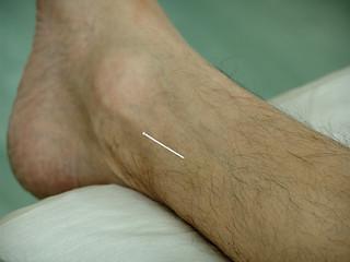 Image showing Acupuncture