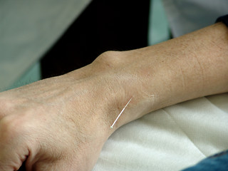 Image showing Acupuncture