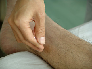 Image showing Acupuncture