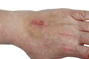 Image showing Laceration