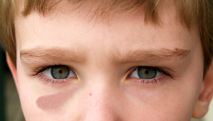 Image showing boy with black eye