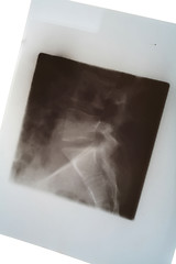 Image showing Medical X-ray of spine