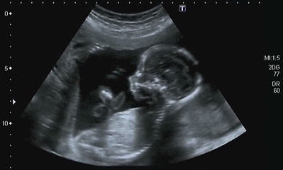 Image showing Obstetric Ultrasonography