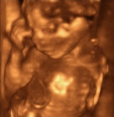 Image showing Three Dimensional Ultrasound