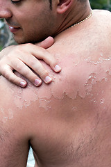 Image showing Painful Peeling Sunburn