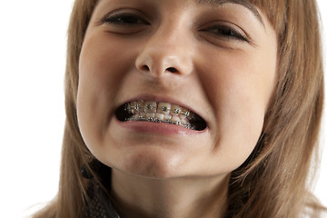 Image showing Girl smiles with bracket on teeth