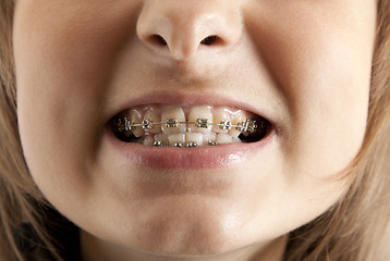 Image showing Girl smiles with bracket on teeth