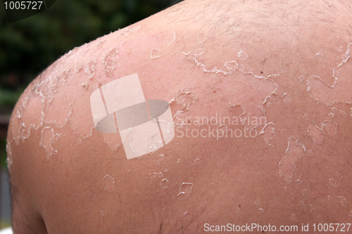 Image of Peeling Sunburned Back