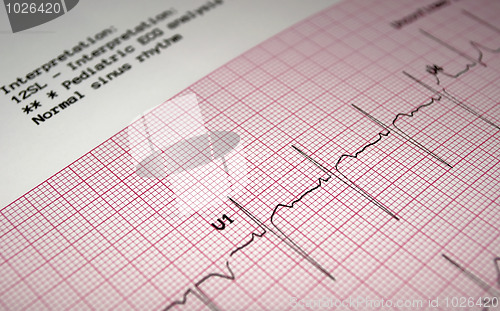 Image of Pediatric electrocardiogram.