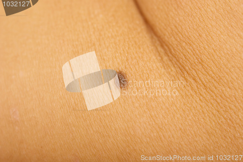 Image of mole