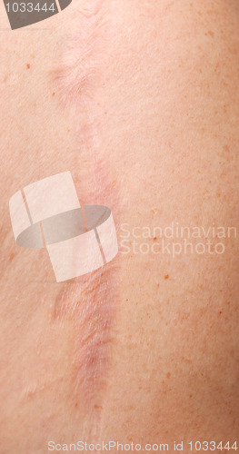 Image of skin scar