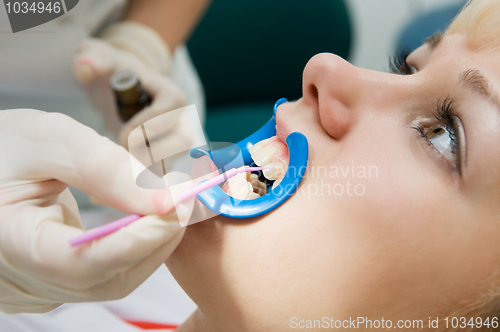 Image of dental procedure of teeth protecting