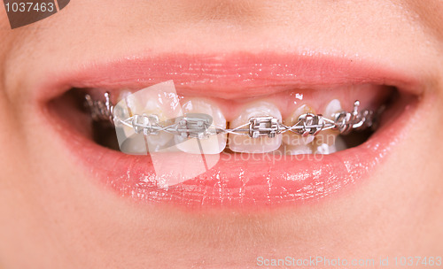 Image of braces