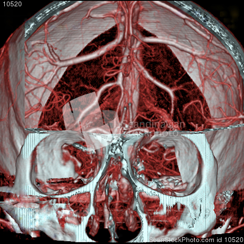 Image of A real MRI/ MRA (Magnetic Resonance Angiogram) of the brain vasculature (arteries).  This MRI study is  often used to show/find brain aneurysms.