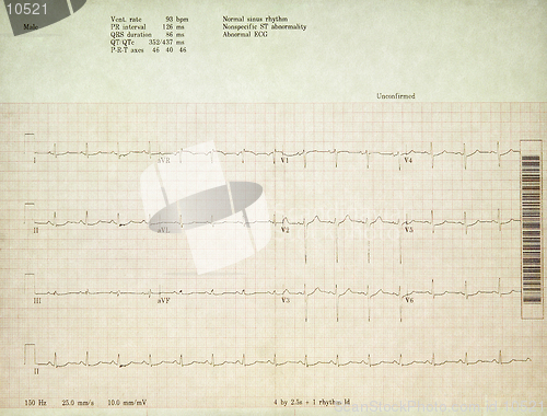 Image of A real 12 Lead EKG.