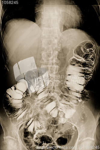 Image of Irrigoscopy