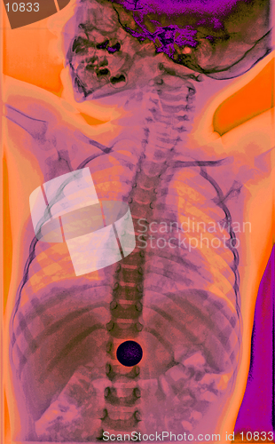 Image of This is a colorized x-ray of a child who swallowed money (penny). Many visits to the ER by kids are for FBOs (Foreign Body Objects).  He did fine.  Colors carefully rendered to show anatomy.